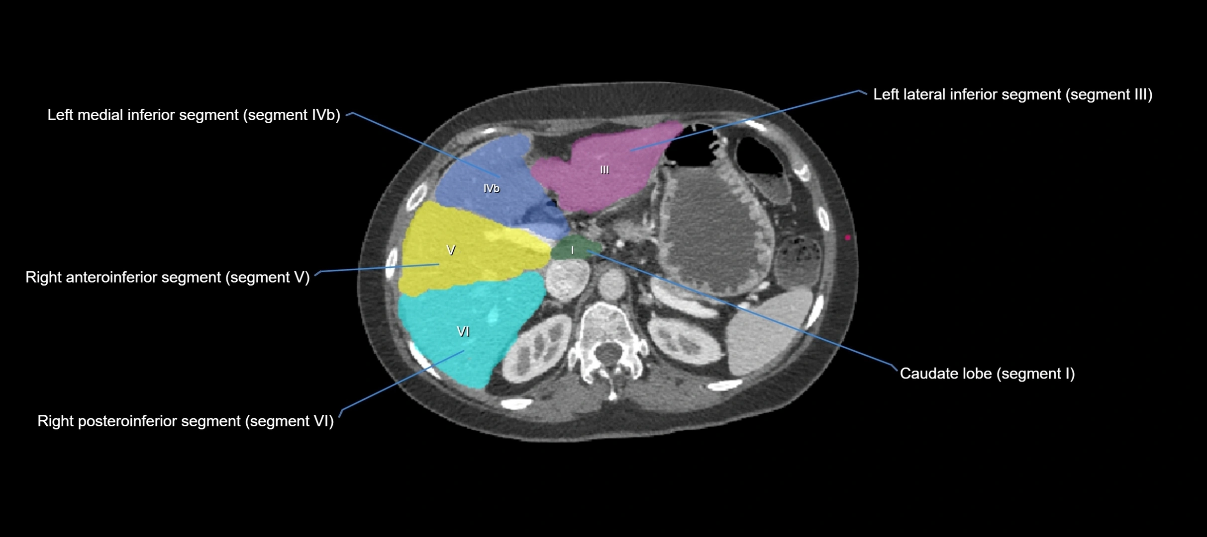 CT liver segments axial cross sectional anatomy labelled image-00045.webp
